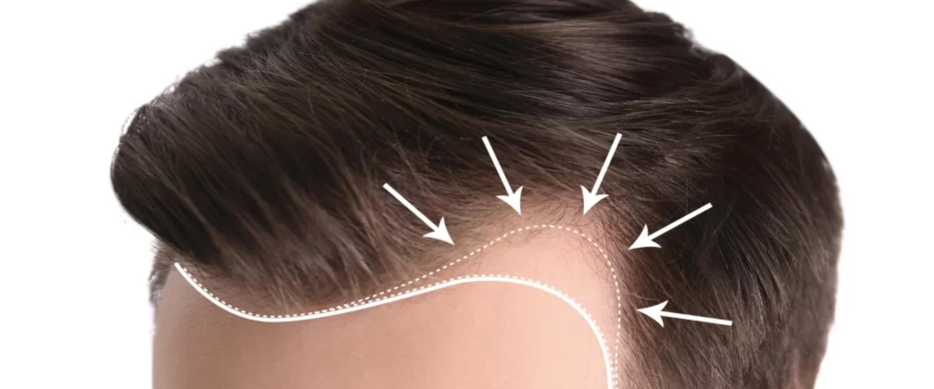 Így alakítható ki az ideális hajvonal hajbeültetéskor