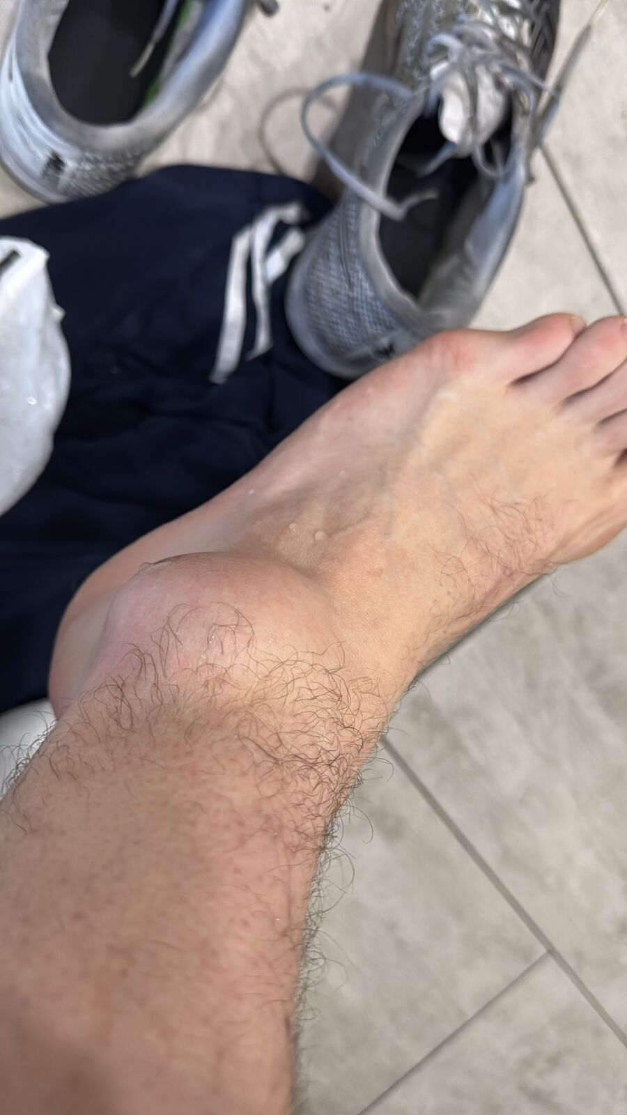 huNter- s&eacute;r&uuml;lt l&aacute;ba a gipszel&eacute;s előtt - forr&aacute;s: huNter- / Twitter